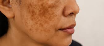 Dark Spots After Acne: How to Prevent & Treat Post-Inflammatory Hyperpigmentation
