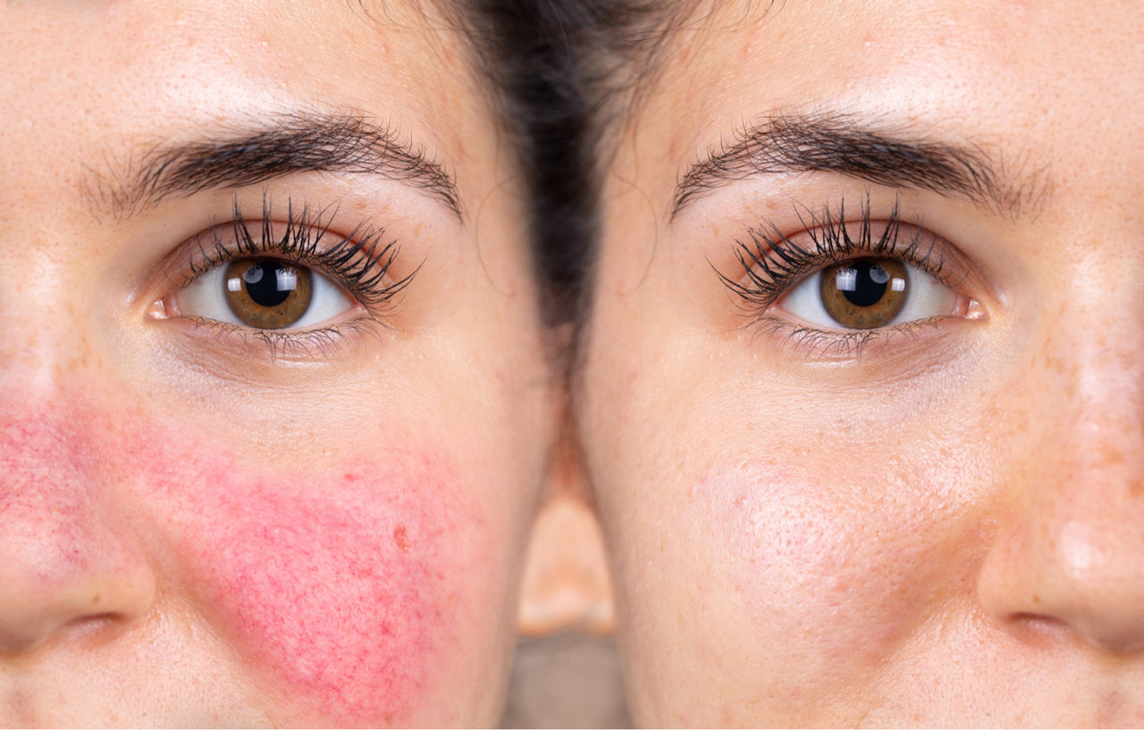 Rosacea Management: Skincare, Diet, and Environmental Triggers