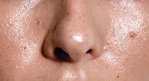 Dealing with Oily Skin in Humid Climates: Tips, Products, Lifestyle Hacks