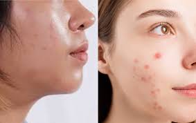 How to Choose Fragrance-Free / Non-Comedogenic Products for Acne-Prone Skin