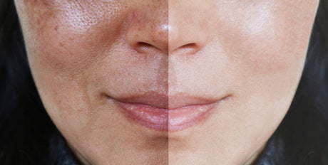 The Ultimate Guide to Treating Hyperpigmentation for All Skin Tones
