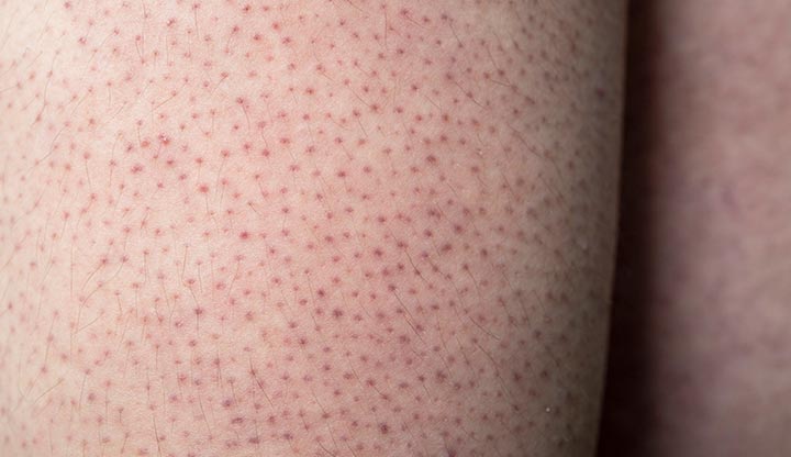 Body Skincare Concerns: Keratosis Pilaris, Dryness, Pigmentation