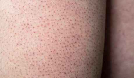 Body Skincare Concerns: Keratosis Pilaris, Dryness, Pigmentation